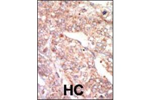 Formalin-fixed and paraffin-embedded human cancer tissue reacted with the primary antibody, which was peroxidase-conjugated to the secondary antibody, followed by AEC staining. (EPHA1 antibody  (N-Term))