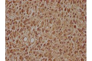 IHC image of ABIN7143497 diluted at 1:100 and staining in paraffin-embedded human glioma cancer performed on a Leica BondTM system. (ARL2BP antibody  (AA 1-163))