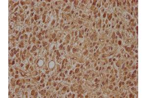 IHC image of ABIN7143497 diluted at 1:100 and staining in paraffin-embedded human glioma cancer performed on a Leica BondTM system.