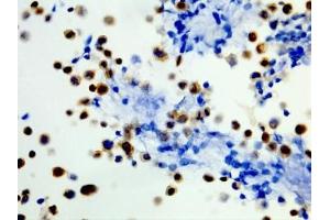 ICC staining of formalin fixed and paraffin embedded human WiDr cells (400X, Positive) with recombinant BRAF V600E antibody. (Recombinant BRAF antibody  (Val600Glu-Mutant))