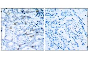 Immunohistochemical analysis of paraffin-embedded human breast carcinoma tissue, using CDC2 (phospho-Thr161) antibody (E011134). (CDK1 antibody  (pThr161))