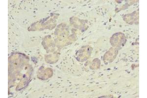 Immunohistochemistry of paraffin-embedded human gastric cancer using ABIN7158529 at dilution of 1:100