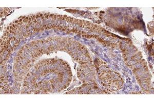 ABIN6267087 at 1/100 staining Human thyroid cancer tissue by IHC-P.