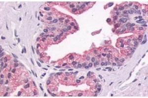 Immunohistochemical (Formalin/PFA-fixed paraffin-embedded sections) staining in human prostate, epithelium with GPR87 polyclonal antibody . (GPR87 antibody  (Extracellular Domain))
