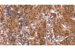 Immunohistochemistry of paraffin-embedded Human gastric cancer using GUK1 Polyclonal Antibody at dilution of 1:50