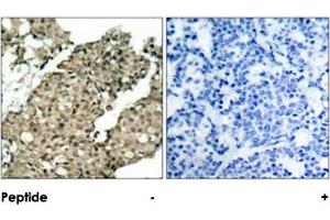 Imunohistochemical analysis of paraffin-embedded human breast carcinoma tissue, using G3BP1 (phospho S232) polyclonal antibody  (A) or preincubated with blocking peptide (B). (G3BP1 antibody  (pSer232))