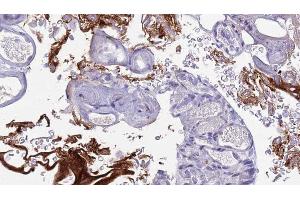 ABIN6273442 at 1/100 staining Human urothelial cancer tissue by IHC-P. (CD177 antibody  (Internal Region))