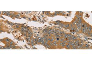 Immunohistochemistry of paraffin-embedded Human gastric cancer tissue using XPR1 Polyclonal Antibody at dilution of 1:45(x200) (xpr1 antibody)