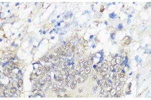Immunohistochemistry of paraffin-embedded Human colon carcinoma using GPX2 Polyclonal Antibody at dilution of 1:100 (40x lens). (Glutathione Peroxidase 2 antibody)