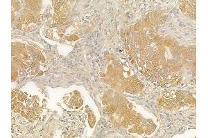 ABIN6263074 and ABIN6278147 at 1/100 staining human lung squamous cell carcinoma by IHC-P. (Melanoma Antigen Family D, 4 (MAGED4) (N-Term) antibody)