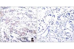 Immunohistochemistry analysis of paraffin-embedded human breast carcinoma tissue, using Elk1 (Ab-383) Antibody. (ELK1 antibody  (AA 351-400))