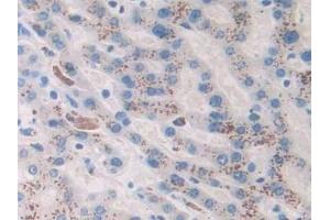 Detection of Ang1-7 in Human Liver cancer Tissue using Monoclonal Antibody to Angiotensin 1-7 (Ang1-7) (Angiotensin 1-7 antibody)