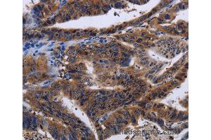 Immunohistochemistry of Human liver cancer using HTR2B Polyclonal Antibody at dilution of 1:60
