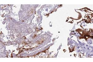 ABIN6273445 at 1/100 staining Human urothelial cancer tissue by IHC-P. (CD27 antibody  (Internal Region))