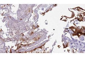 ABIN6273445 at 1/100 staining Human urothelial cancer tissue by IHC-P.