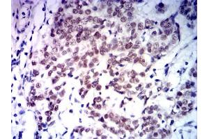 Immunohistochemical analysis of paraffin-embedded bladder cancer tissues using MLH1 mouse mAb with DAB staining. (MLH1 antibody  (AA 381-483))