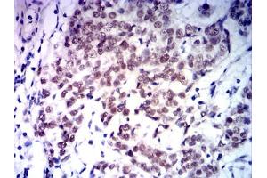Immunohistochemical analysis of paraffin-embedded bladder cancer tissues using MLH1 mouse mAb with DAB staining. (MLH1 antibody  (AA 381-483))