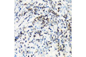Immunohistochemistry of paraffin-embedded human lung cancer using CSK Rabbit mAb (ABIN1513217, ABIN3021034, ABIN3021035 and ABIN7101334) at dilution of 1:100 (40x lens). (CSK antibody)