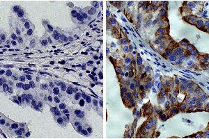 Paraffin embedded human gastric cancer tissue was stained with Mouse IgG2a-HRP isotype control followed by DAB and hematoxylin. (KRT8 antibody  (HRP))