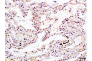 Formalin-fixed and paraffin embedded human lung carcinoma labeled with Anti-Ubiquityl Histone H2A. (H2AFX antibody  (ubLys119))