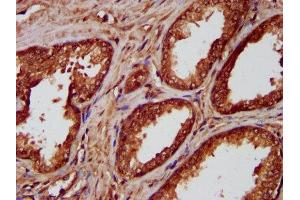 IHC image of ABIN7155827 diluted at 1:300 and staining in paraffin-embedded human prostate cancer performed on a Leica BondTM system. (NKX2-8 antibody  (AA 1-160))