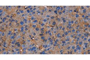 Immunohistochemistry of paraffin-embedded Human liver cancer tissue using NRIP3 Polyclonal Antibody at dilution 1:60 (NRIP3 antibody)