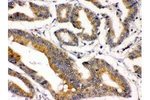 IHC(P): Human Intestinal Cancer Tissue (BMP2 antibody  (C-Term))
