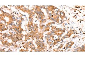 Immunohistochemistry of paraffin-embedded Human colon cancer tissue using CELSR2 Polyclonal Antibody at dilution 1:50 (CELSR2 antibody)