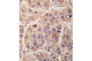 Formalin-fixed and paraffin-embedded human hepatocarcinoma tissue reacted with PIM3 antibody , which was peroxidase-conjugated to the secondary antibody, followed by DAB staining. (PIM3 antibody  (C-Term))