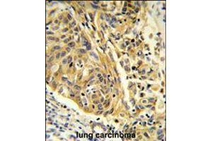 Formalin-fixed and paraffin-embedded human lung carcinoma reacted with CLTA Antibody , which was peroxidase-conjugated to the secondary antibody, followed by DAB staining.