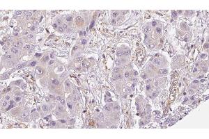 ABIN6273954 at 1/100 staining Human liver cancer tissue by IHC-P. (OR2A12 antibody  (C-Term))
