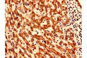 Immunohistochemistry analysis of human liver cancer using ABIN7171128 at dilution of 1:100 (SYNJ2BP antibody  (AA 1-117))