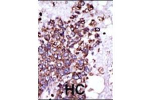 Formalin-fixed and paraffin-embedded human cancer tissue reacted with the primary antibody, which was peroxidase-conjugated to the secondary antibody, followed by DAB staining. (CAMK1 antibody  (C-Term))