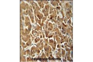 ATP5G2 antibody (C-term) (ABIN652087 and ABIN2840542) immunohistochemistry analysis in formalin fixed and paraffin embedded human hepatocarcinoma followed by peroxidase conjugation of the secondary antibody and DAB staining. (ATP5G2 antibody  (C-Term))
