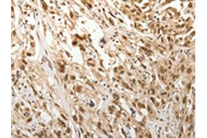 The image on the left is immunohistochemistry of paraffin-embedded Human esophagus cancer tissue using ABIN7189683(ADIPOR2 Antibody) at dilution 1/15, on the right is treated with synthetic peptide. (Adiponectin Receptor 2 antibody)