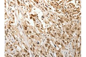 The image on the left is immunohistochemistry of paraffin-embedded Human esophagus cancer tissue using ABIN7189683(ADIPOR2 Antibody) at dilution 1/15, on the right is treated with synthetic peptide. (Adiponectin Receptor 2 antibody)