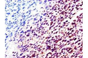 Immunohistochemistry of paraffin-embedded human glioma using ABIN7157858 at dilution of 1:100