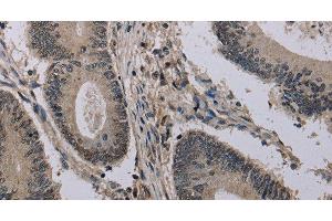 Immunohistochemistry of paraffin-embedded Human colon cancer using HIST1H2AH Polyclonal Antibody at dilution of 1:40 (HIST1H2AH antibody)
