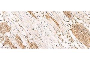 Immunohistochemistry of paraffin-embedded Human esophagus cancer tissue using POP4 Polyclonal Antibody at dilution of 1:65(x200)