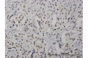 Immunoperoxidase of monoclonal antibody to RNF168 on formalin-fixed paraffin-embedded human prostate cancer. (RNF168 antibody  (AA 462-571))