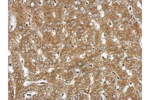 IHC-P Image Immunohistochemical analysis of paraffin-embedded human hepatoma, using NDST3, antibody at 1:500 dilution. (NDST3 antibody  (Center))