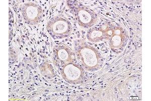 Formalin-fixed and paraffin embedded human rhinopolypus labeled with Rabbit Anti IL-23 Polyclonal Antibody, Unconjugated (ABIN673179) at 1:200 followed by conjugation to the secondary antibody and DAB staining