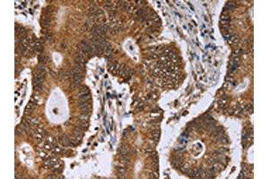 The image on the left is immunohistochemistry of paraffin-embedded Human colon cancer tissue using ABIN7129394(ERCC6L Antibody) at dilution 1/30, on the right is treated with fusion protein.