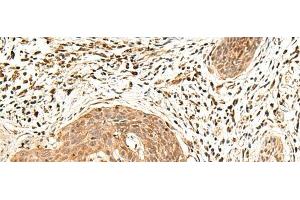 Immunohistochemistry of paraffin-embedded Human esophagus cancer tissue using LDHA Polyclonal Antibody at dilution of 1:25(x200) (Lactate Dehydrogenase A antibody)