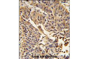Formalin-fixed and paraffin-embedded human lung carcinoma reacted with JUP Antibody , which was peroxidase-conjugated to the secondary antibody, followed by DAB staining.