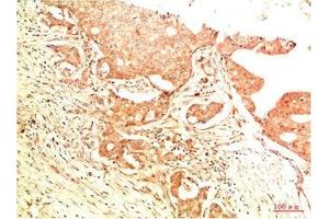 Immunohistochemical analysis of paraffin-embedded Human Breast Carcinoma Tissue using Acetyl P53(K382) Mouse mAb diluted at 1:200. (p53 antibody  (acLys382))
