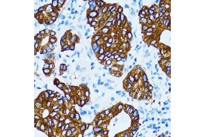Immunohistochemistry of paraffin-embedded human gastric cancer using Cathepsin E (CTSE) antibody (ABIN3016440, ABIN3016441, ABIN3016442 and ABIN6219747) at dilution of 1:100 (40x lens). (Cathepsin E antibody)