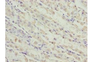 Immunohistochemistry of paraffin-embedded human gastric cancer using ABIN7173119 at dilution of 1:100 (TMEM19 antibody  (AA 105-217))