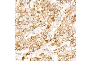 Immunohistochemistry of paraffin-embedded human liver cancer using PFKP antibody (ABIN7269309) at dilution of 1:100 (40x lens). (PFKP antibody)