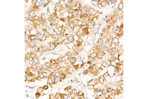 Immunohistochemistry of paraffin-embedded human liver cancer using PFKP antibody (ABIN7269309) at dilution of 1:100 (40x lens).
